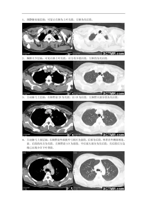胸部CT断层解剖_肺叶-肺段(图文)