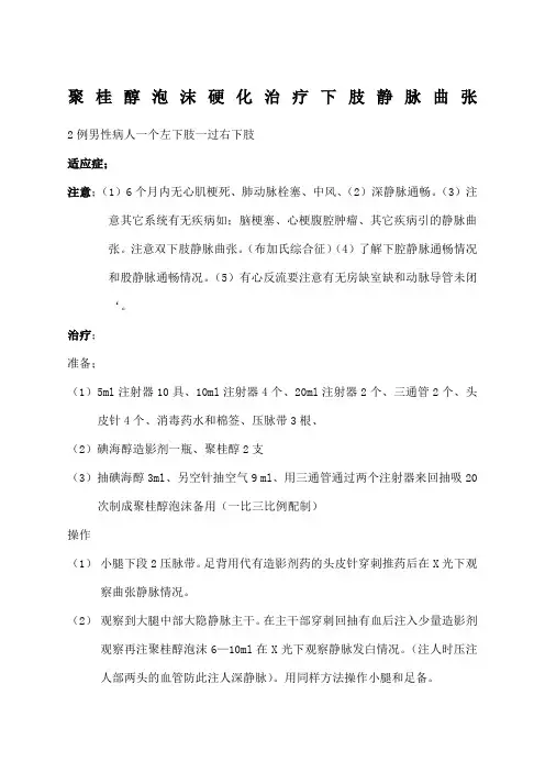 聚桂醇泡沫硬化治疗下肢静脉曲张