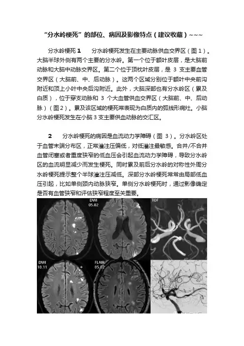 “分水岭梗死”的部位、病因及影像特点（建议收藏）~~~