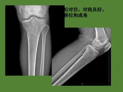 骨与关节创伤影像专业教学PPT课件