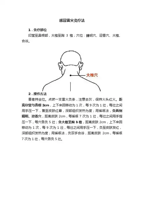 感冒雷火灸疗法