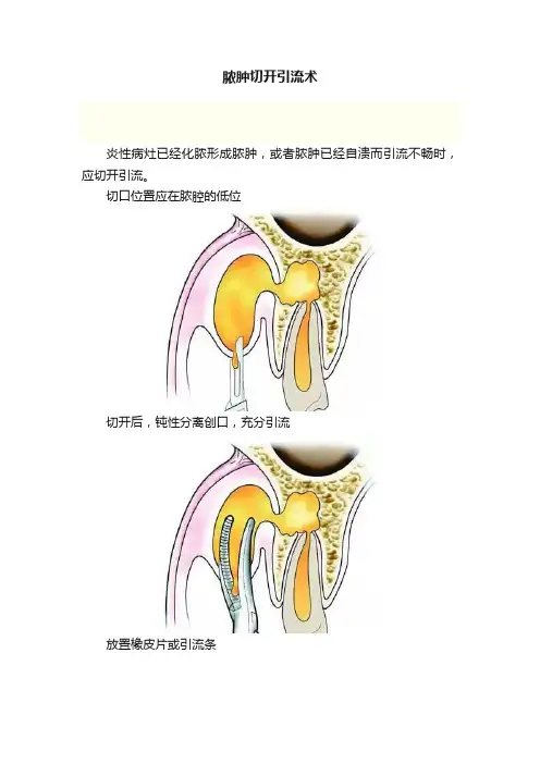 脓肿切开引流术