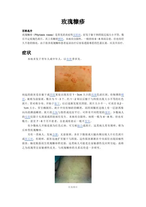 玫瑰康疹