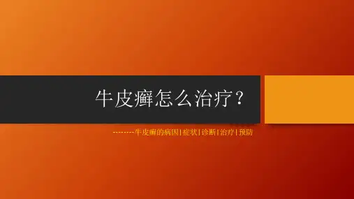 牛皮癣怎么治疗(怎么办？)的病因、症状、诊断、治疗、预防