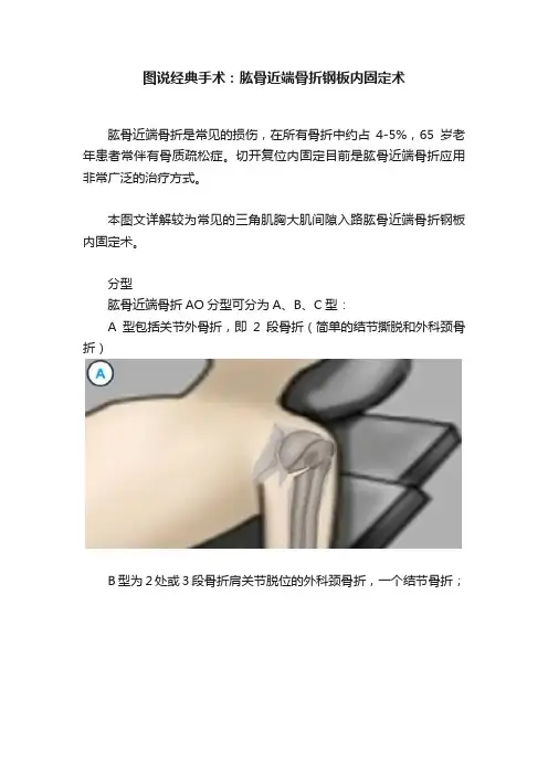 图说经典手术：肱骨近端骨折钢板内固定术