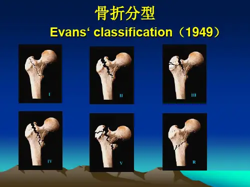 pfna治疗股骨粗隆间骨折ppt课件