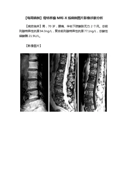 【每周病例】骨转移瘤MRI-X线病例图片影像诊断分析
