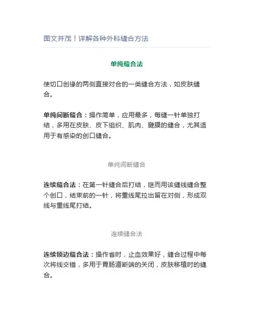 图文并茂详解各种外科缝合方法
