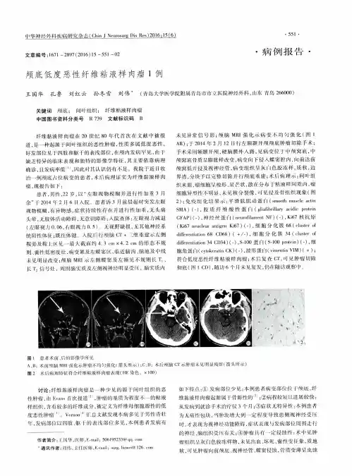 颅底低度恶性纤维粘液样肉瘤1例