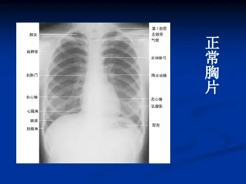 X线读片培训资料临床执业医师实践技能考试读片精选