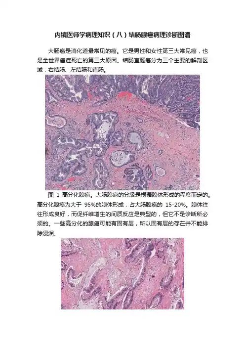内镜医师学病理知识(八)结肠腺癌病理诊断图谱