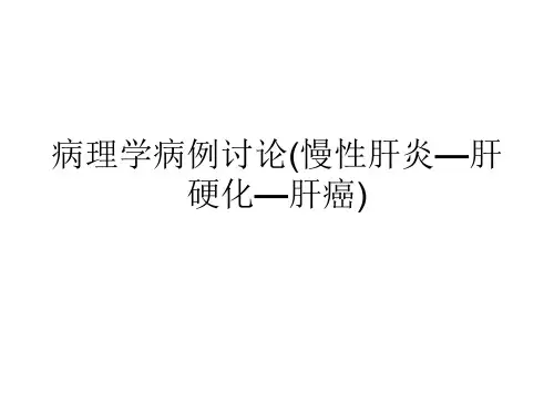 病理学病例讨论(慢性肝炎—肝硬化—肝癌)