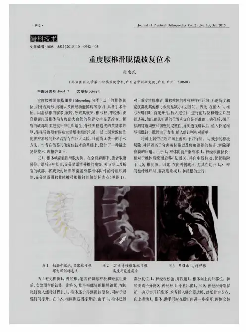 重度腰椎滑脱撬拨复位术