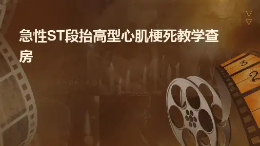 急性ST段抬高型心肌梗死教学查房