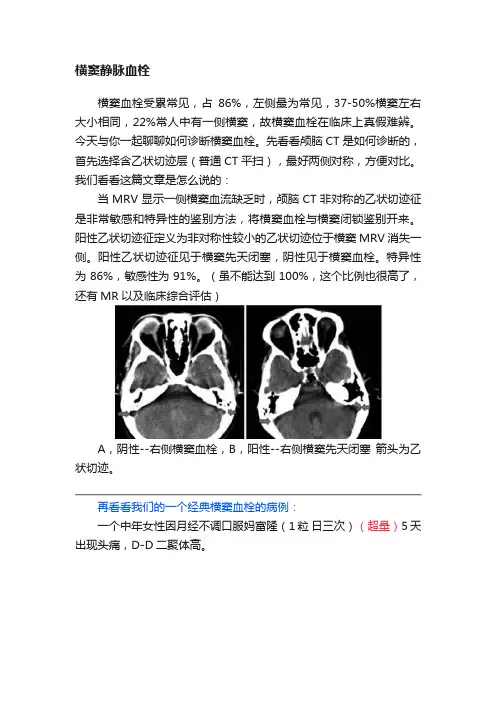 横窦静脉血栓