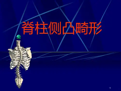 脊柱侧弯PPT课件