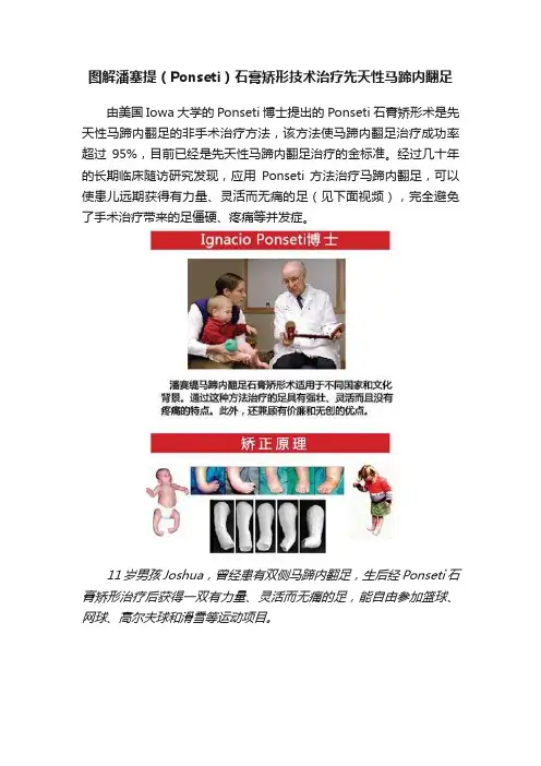 图解潘塞提（Ponseti）石膏矫形技术治疗先天性马蹄内翻足