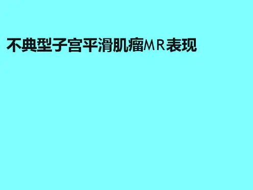 子宫肌瘤不典型MRI表现
