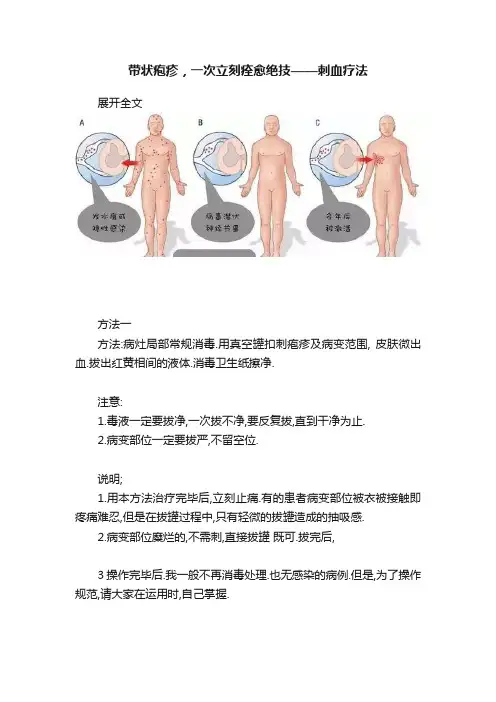 带状疱疹，一次立刻痊愈绝技——刺血疗法