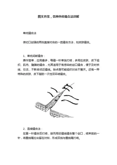 图文并茂，各种外科缝合法详解