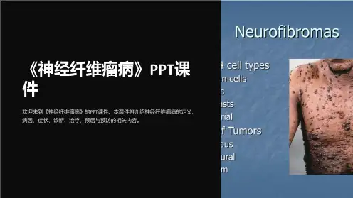《神经纤维瘤病》课件
