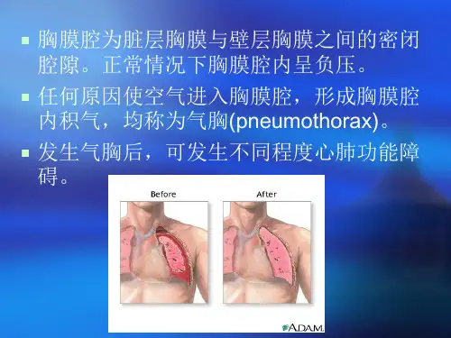 内科学 第十一章 自发性气胸_PPT课件
