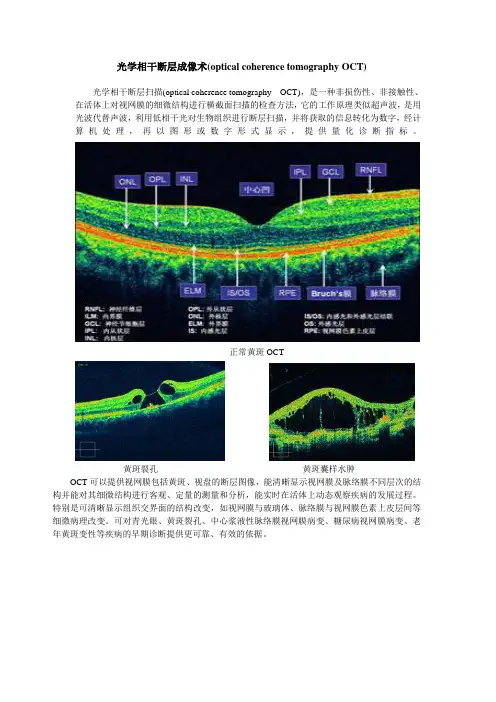 光学相干断层成像术