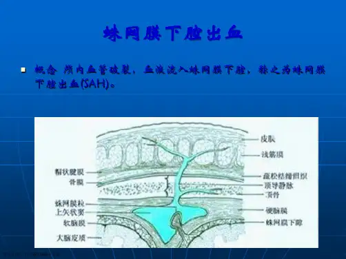 蛛网膜下腔出血MicrosoftPowerPoint演示文稿