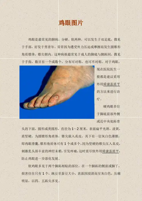 鸡眼图片