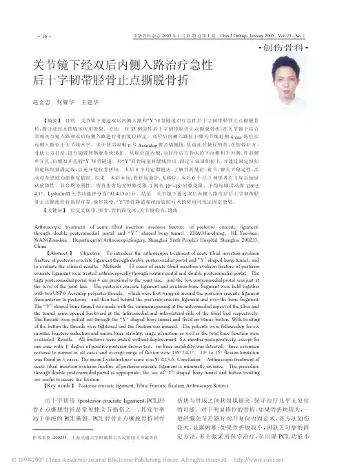 关节镜下经双后内侧入路治疗急性后十字韧带胫骨止点撕脱骨折