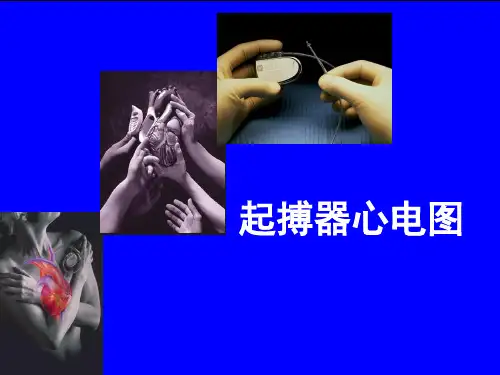 起搏器心电图的解读