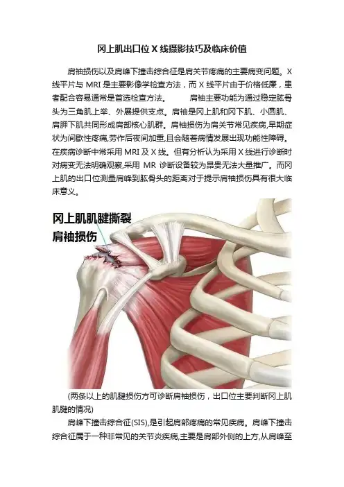 冈上肌出口位X线摄影技巧及临床价值