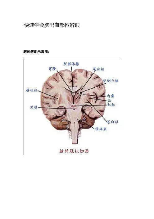 脑出血常见部位