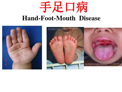 手足口病诊疗的指南2018版解读