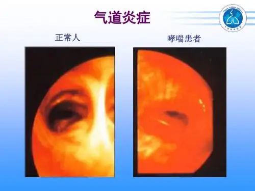 1哮喘诊断和分级
