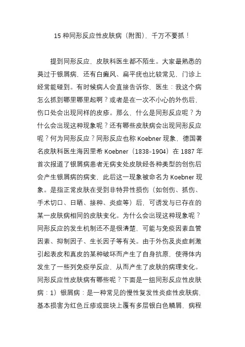 15种同形反应性皮肤病(附图)千万不要抓