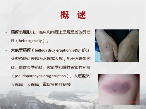 儿科重症药疹诊断及治疗