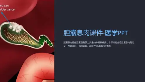 胆囊息肉课件-医学PPT
