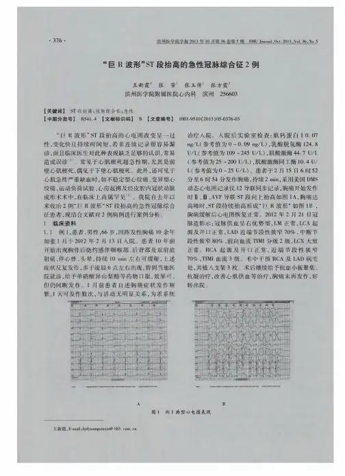 “巨R波形”ST段抬高的急性冠脉综合征2例