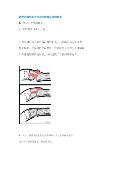 桡骨远端的复位技巧