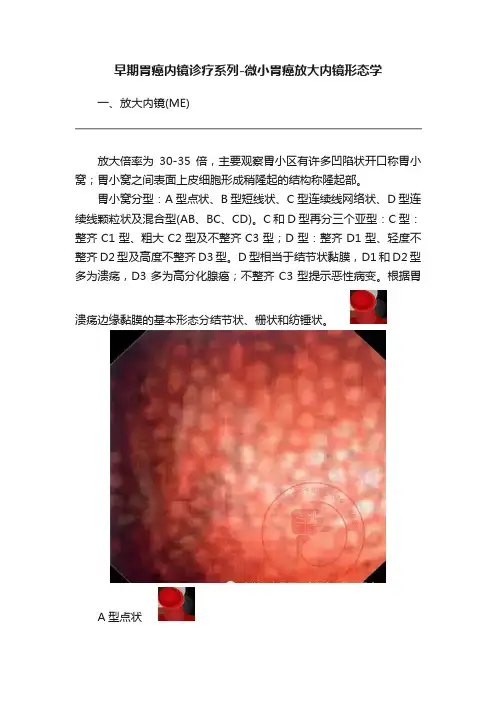 早期胃癌内镜诊疗系列-微小胃癌放大内镜形态学