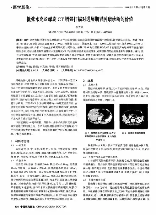 低张水充盈螺旋CT增强扫描对进展期胃肿瘤诊断的价值