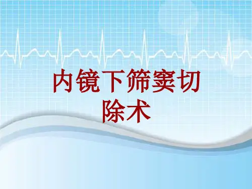 手术讲解模板：内镜下筛窦切除术