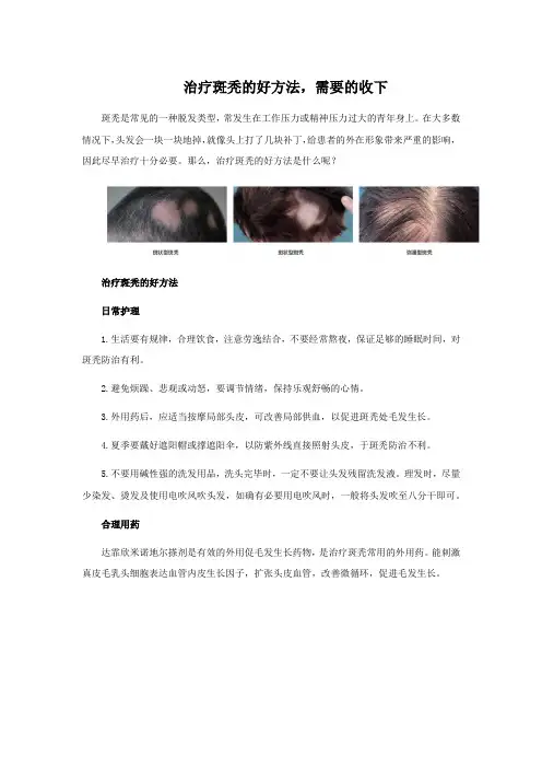 治疗斑秃的好方法-需要的收下