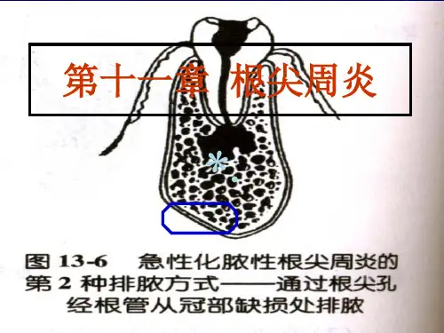 根尖周炎ppt课件