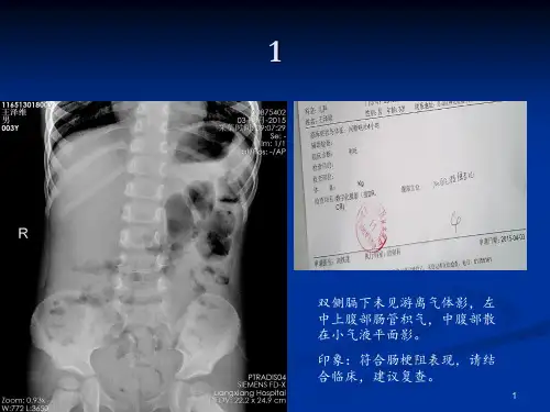 儿科肠梗阻讲课PPT课件