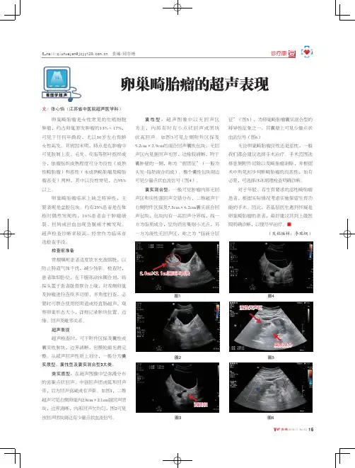 卵巢畸胎瘤的超声表现