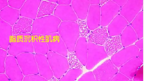 脂质沉积性肌病