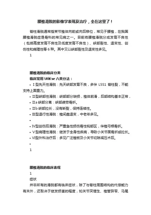 腰椎滑脱的影像学表现及治疗，全在这里了！