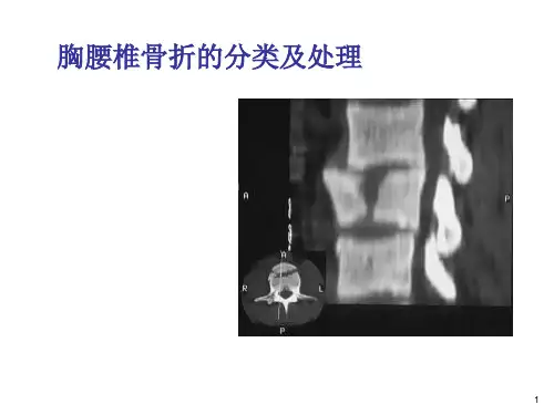 胸腰椎骨折ppt课件